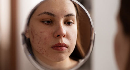 WHAT I NEED TO KNOW BEFORE MY LASER ACNE TREATMENT ?