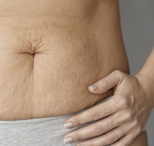 STRETCH MARK; TREATMENT AND CAUSE