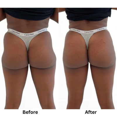 Hip Dip Correction