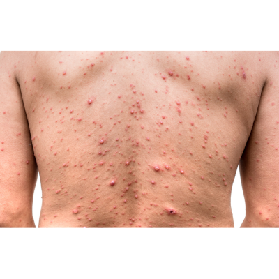 Men: Active Acne Treatment: Body